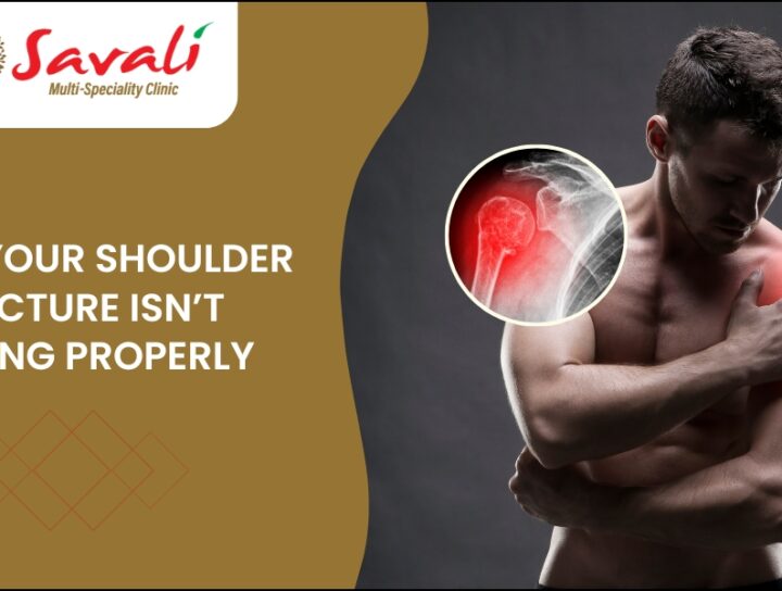 Signs Your Shoulder Fracture Isn’t Healing Properly